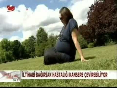 Bağırsak İltihabı Nedir Nasıl Geçer-Crohn Hastalığı Tedavisi Belirtileri Nedenleri