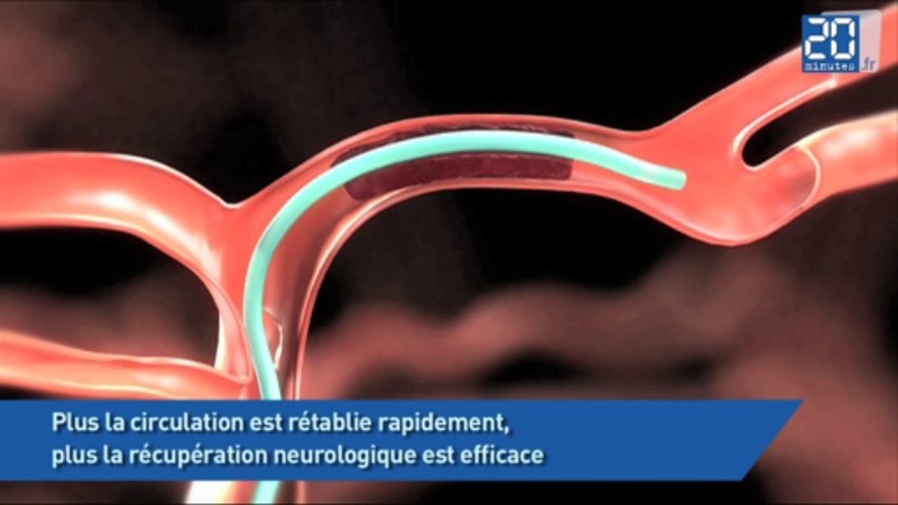 AVC: Comprendre une thrombectomie en 100 secondes