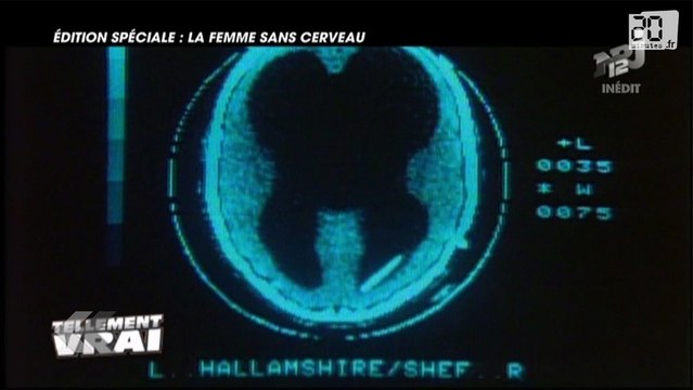 Une femme sans cerveau et en pleine santé.