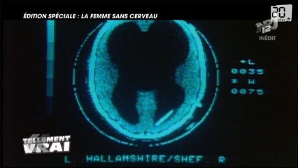 Une femme sans cerveau et en pleine santé.