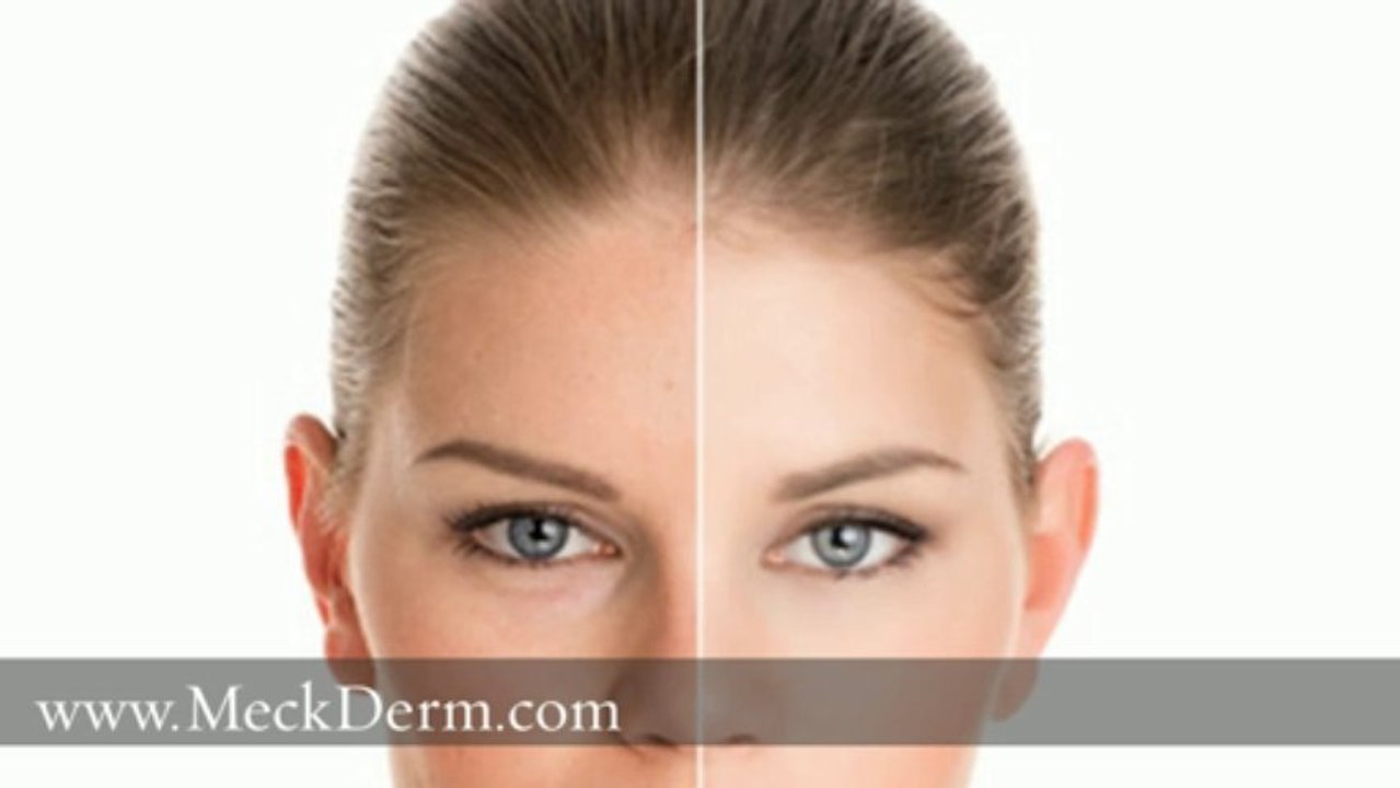 Laser Skin Renewal Charlotte NC 704-344-8846