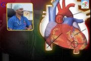 Angioplasty and Stents for Heart Disease Treatment TIps - Dr.A.Sharath Reddy