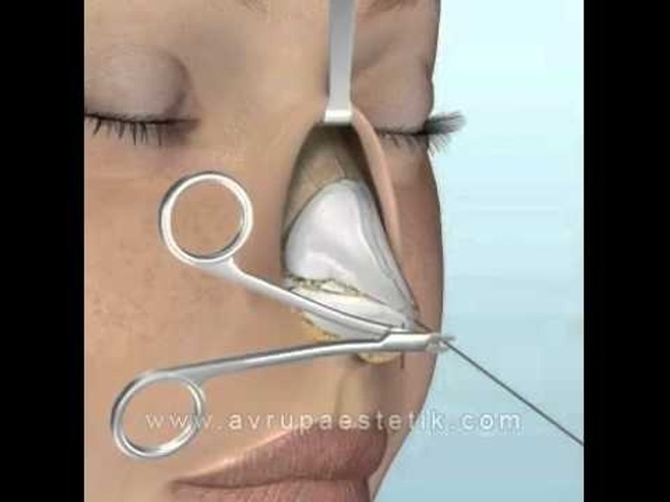 Burun Estetiği Ameliyatı Video İzle- Açık Rinoplasti Videosu, Op Dr H Nazmi Bayçın