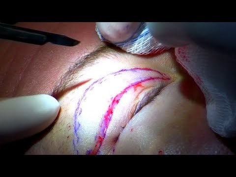 Double eyelid surgery - how blepharoplasty works