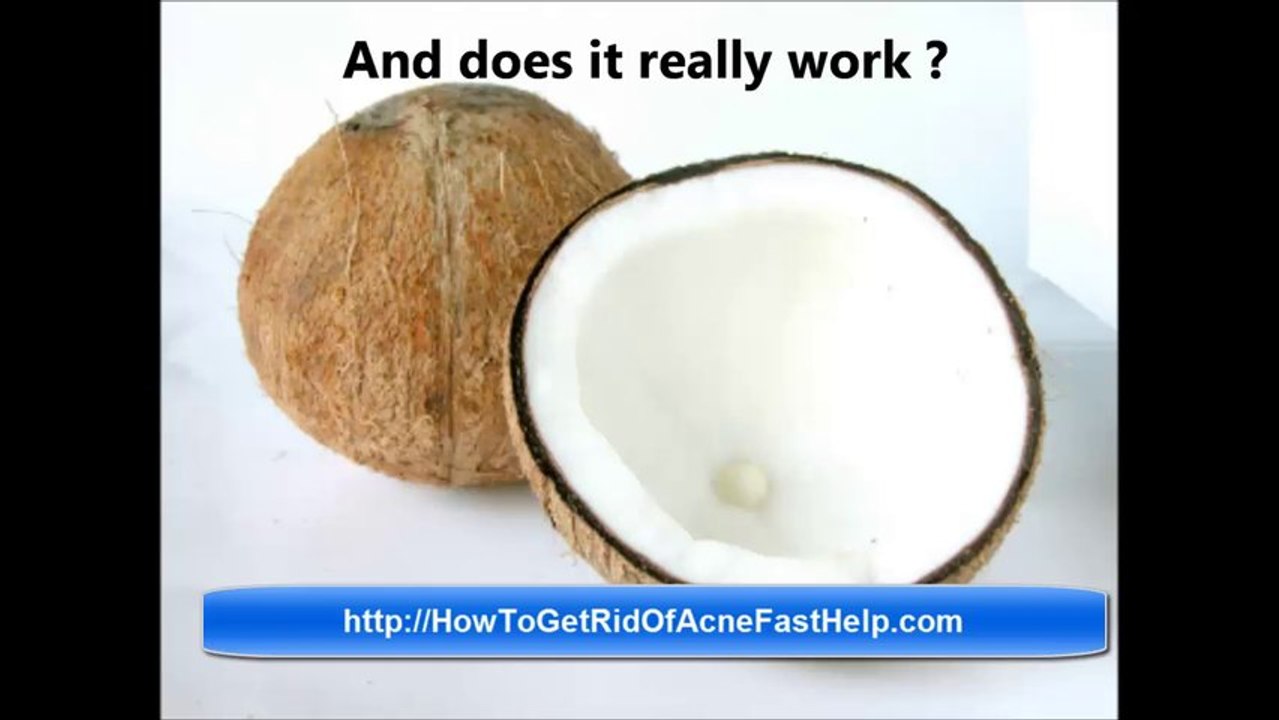 Acne Treatment - Coconut Oil to cure acne
