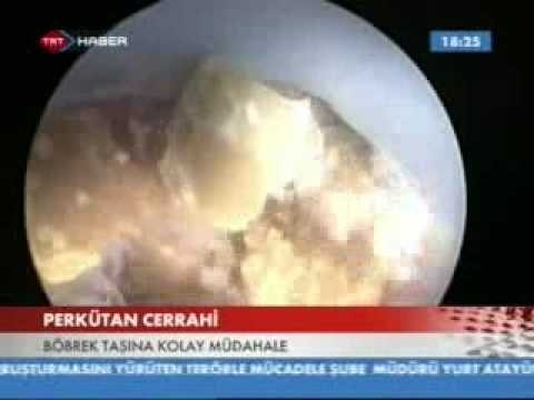 Böbrek Taşı Ameliyatı İle Böbrek Taşları Nasıl Düşürülür