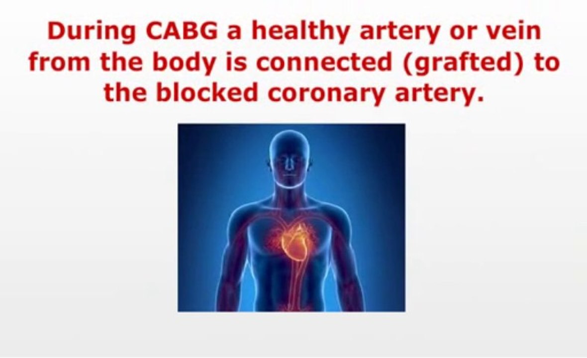 Top Coronary Artery Bypass Graft Surgery Abroad