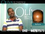 World class treatment for hair transplant @ Oliva cosmetic surgery.