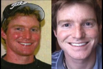 Beating Rosacea and Facial Flushing with Rosadyn