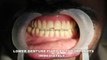 WATCH the simple way to fix your loose lower denture - ALL ON 4 DENTAL IMPLANTS in chennai,india