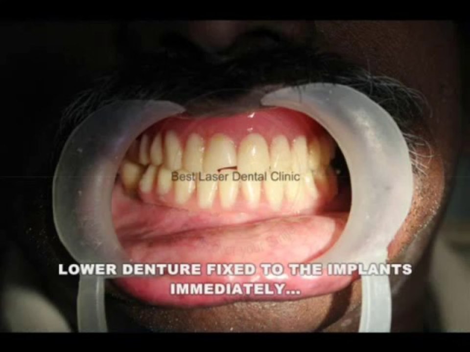 WATCH the simple way to fix your loose lower denture - ALL ON 4 DENTAL IMPLANTS in chennai,india