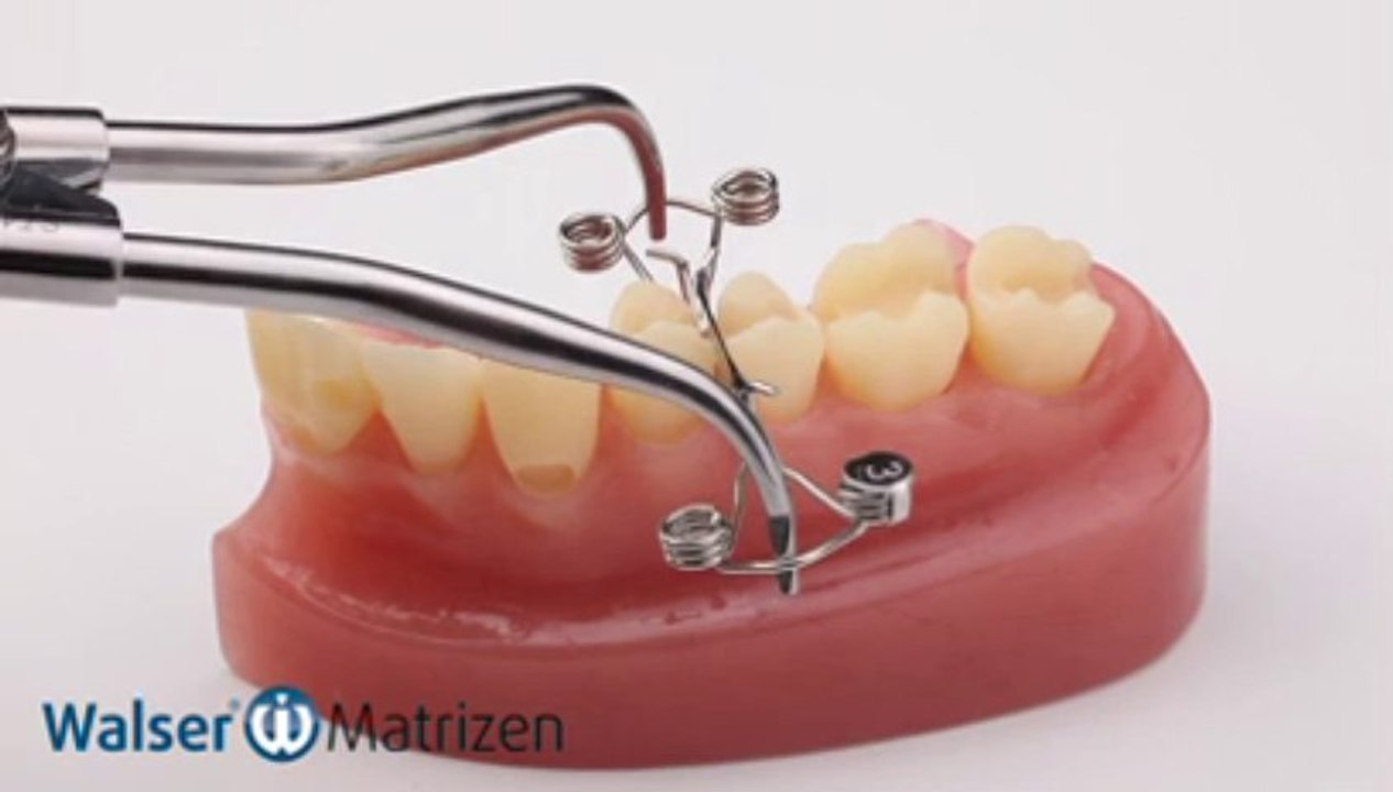 Walser® Teilmatrizen: Anwendung X-Form Zahn Matrize