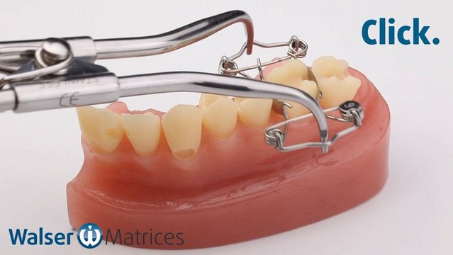 Walser® Sectional Matrix: Application O-form dental matrix