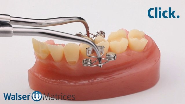 Walser® Sectional Matrix: Application X-form dental matrix