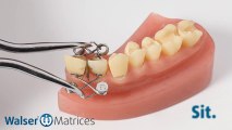 Walser® Sectional Matrices: Application XF-form dental matrix