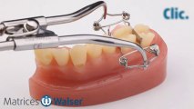 Walser® Matrices Sectionnelles: Utilisation forme O de matrice pour dent