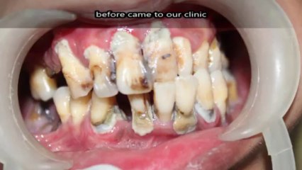 Severe Stage of Genenralised Periodontitis