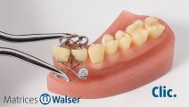 Walser® Matrices Sectionnelles: Utilisation forme XF de matrice pour dent