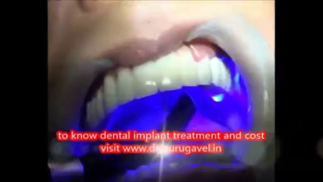 Restoring full arch dental implants with zirconium crown video