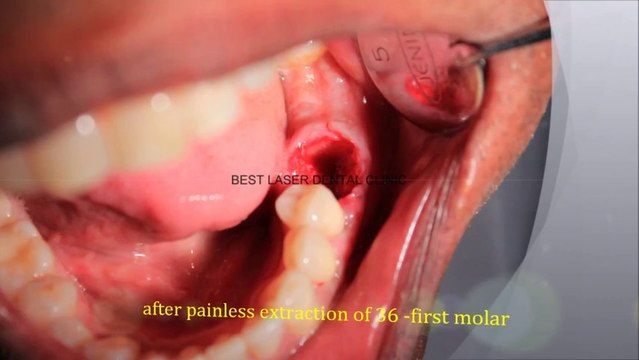 Procedure for dental implant supported zirconium bridge in molar region,chennai,india