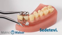 Walser® Matrici Sezionali: L'applicazione forma XF da matrix dentale