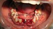 Immediate new teeth replacement by BCS (Basal Cortical Screw) Implants