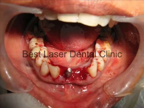 Immediate new teeth replacement by BCS (Basal Cortical Screw) Implants