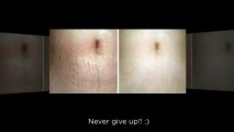 How To Get Rid of Stretch Marks Naturally - Get Rid of Stretch Marks Fast