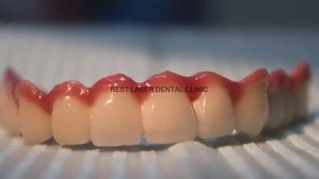 Hybrid denture for dental implant supported bridge!!