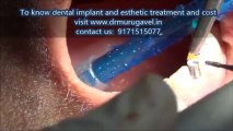 Immediate Dental implant placement in india