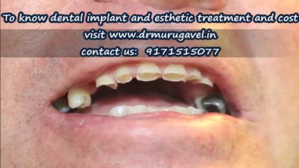 Full mouth rehabilitation and TMD treatment for fully attrited dentition