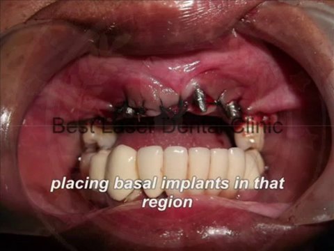 fixed teeth with basal implant without any bonegraft