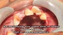 Final stage of generalised periodontitis neglected teeth!!