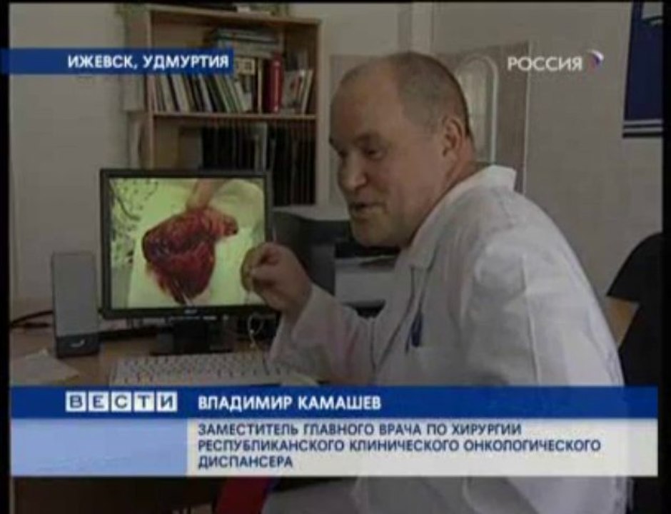 У мужчины вырасла в легких ель