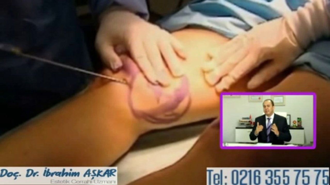 Lazer liposuction ile normal liposuction arasındaki farklar nelerdir