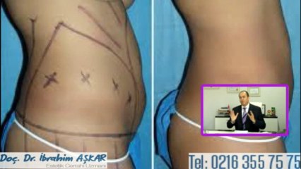 Yağ alma işlemi liposuction ile nasıl yapılır