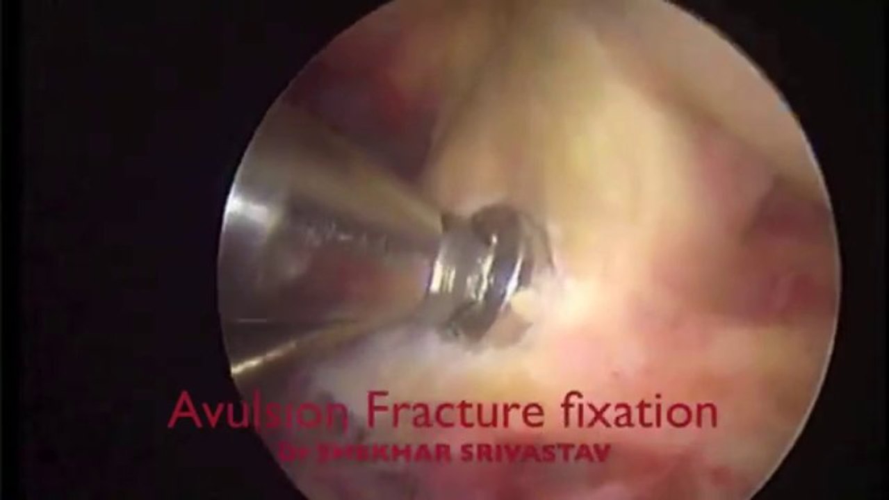 Tibial Spine Avulsion,Tibial Spine Avulsion Fracture Fixation By Dr Shekhar Srivastav