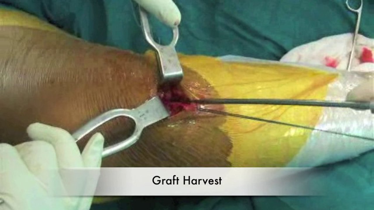 ACL Patient Education,Anterior Cruciate Ligament Surgery,ACL Surgery Delhi