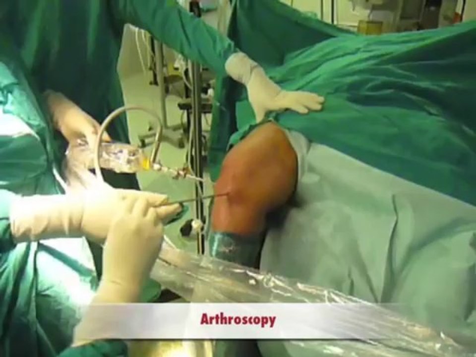 Pt Education Menisectomy,Knee Meniscectomy Delhi By Dr. Shekhar Srivastav