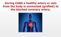 Top Coronary Artery Bypass Graft Abroad