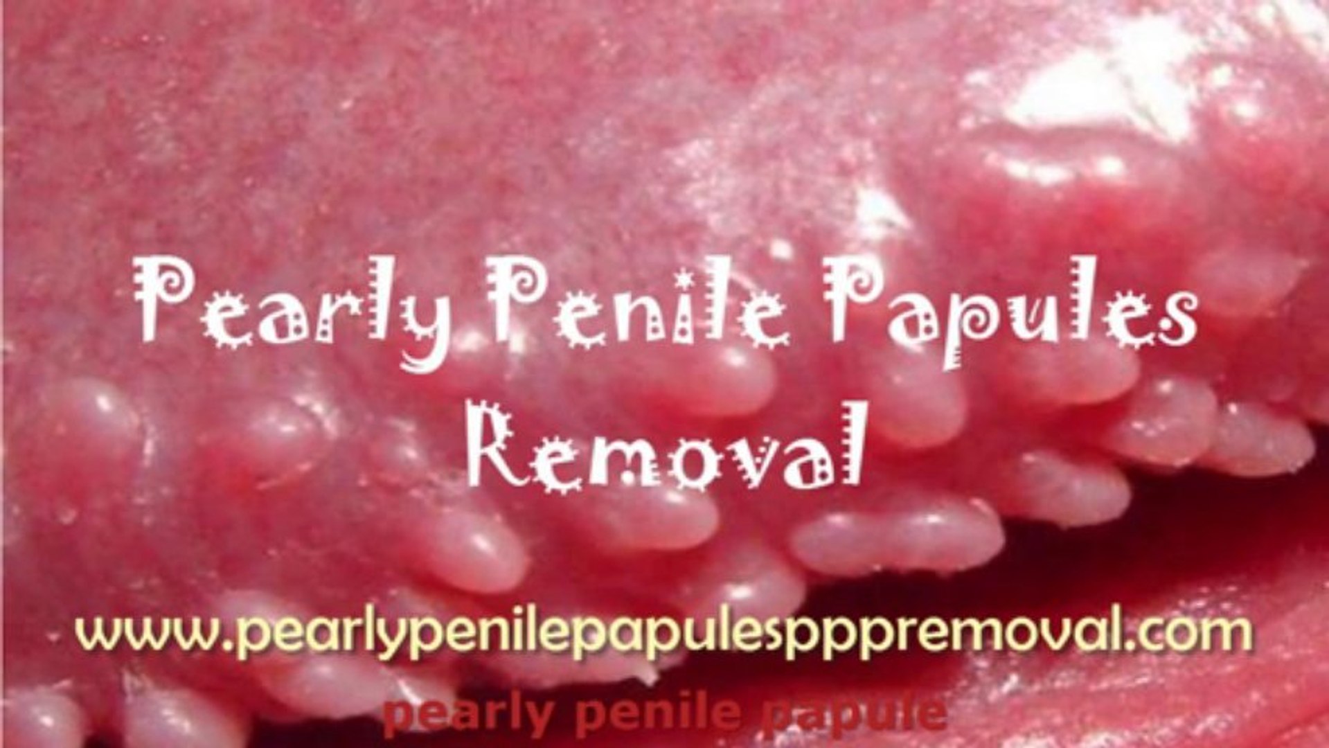 Penile papules how to naturally remove pearly PPP: Pearly