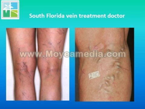 South Florida vein treatment doctor