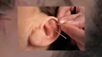 Torrance Acupuncture For Head Pain