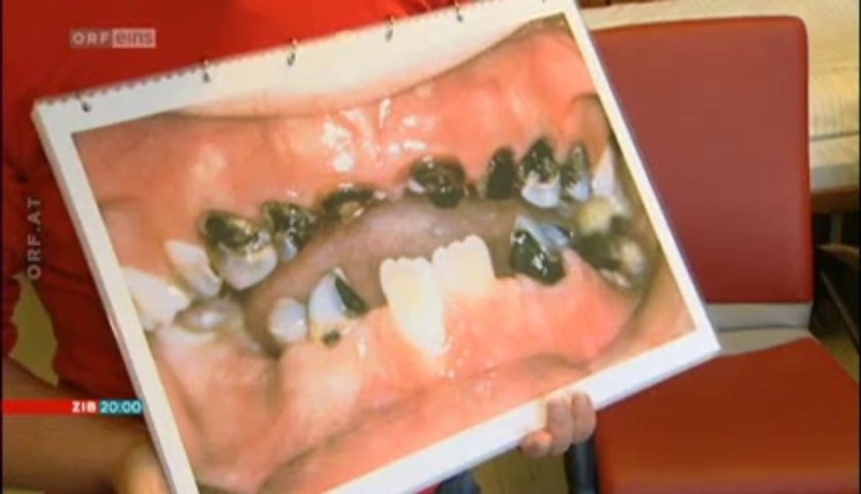 Zahnoperation - Eltern wegen Vernachlässigung verurteilt - 4.j. Laura stirbt