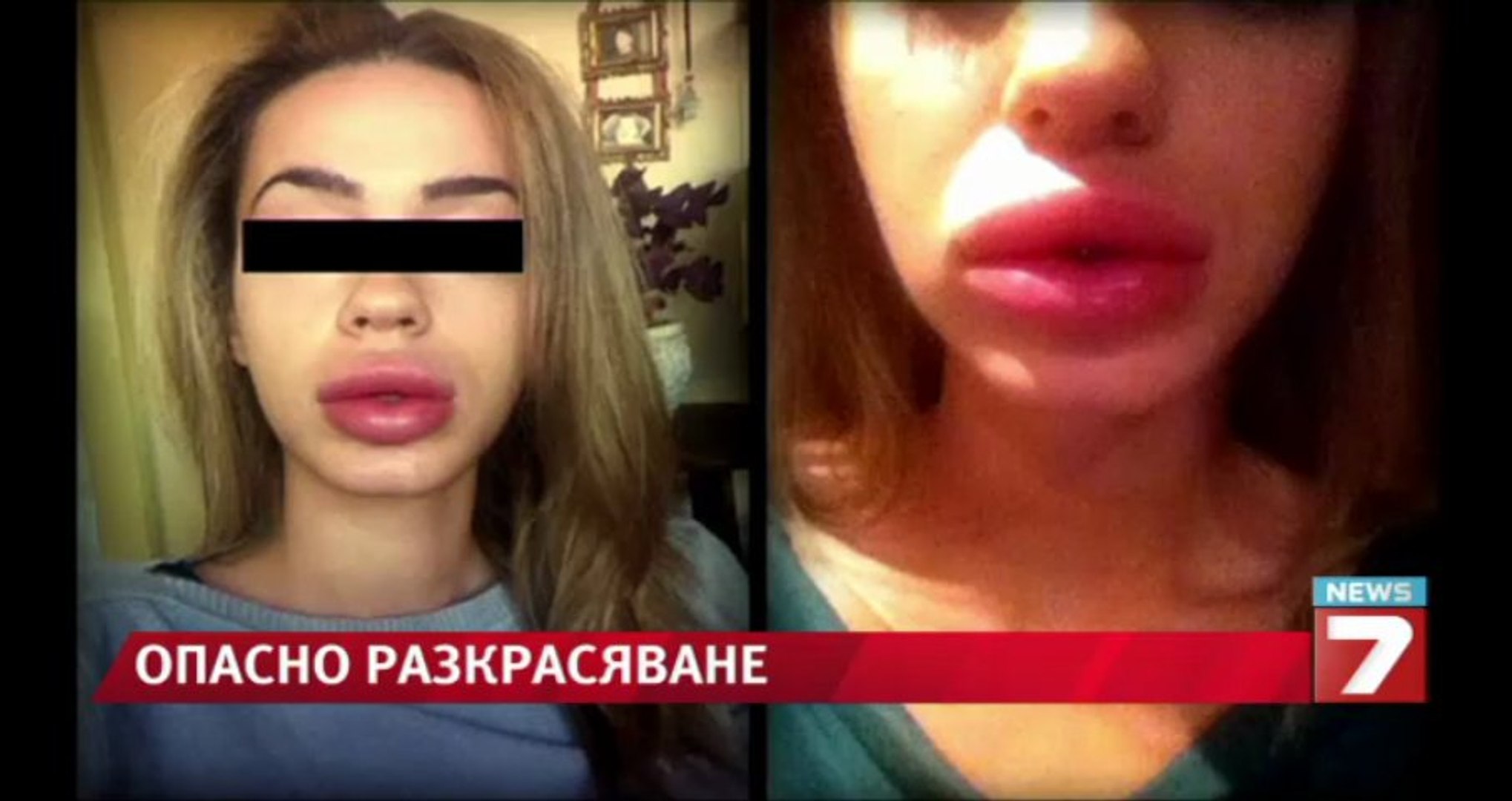 ⁣Опасно разкрасяване / Самозванци правят опасни процедури с витамин Е