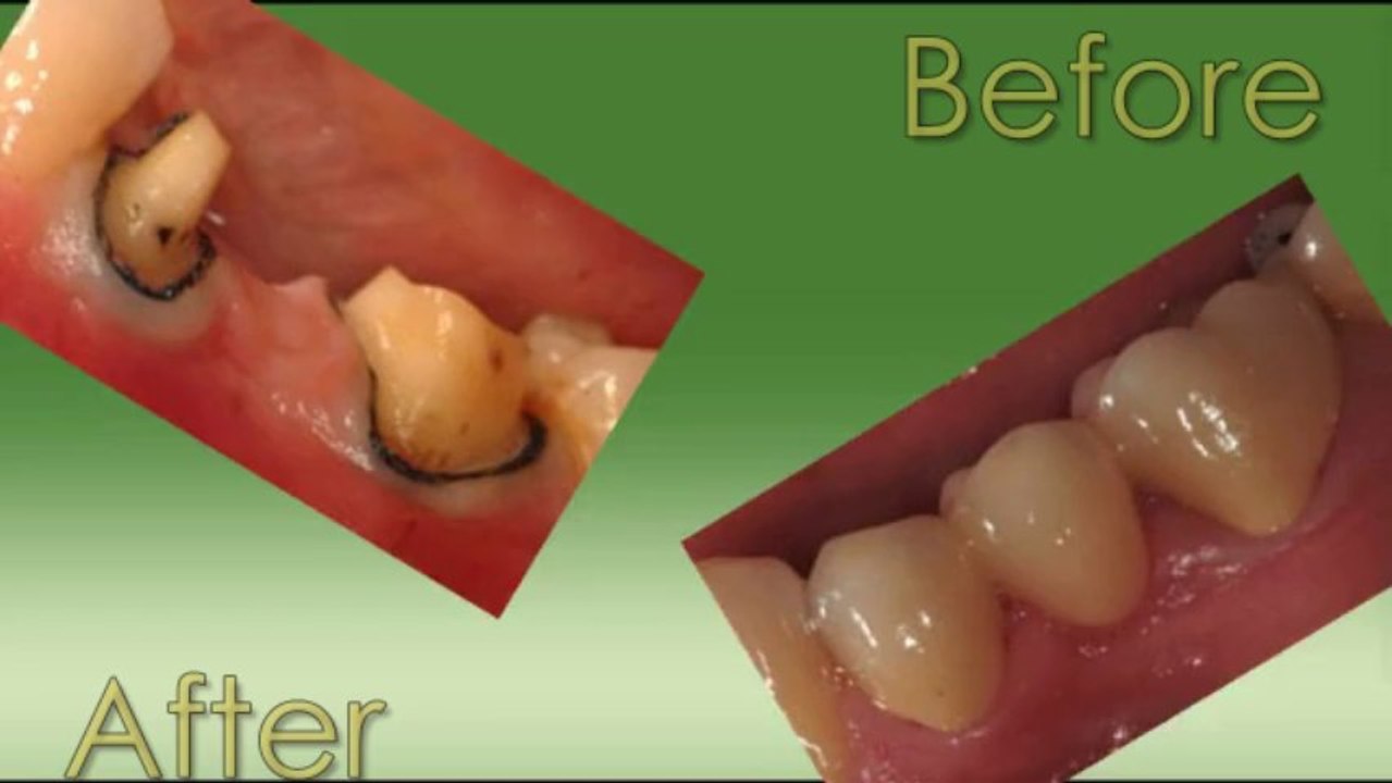 Dental Implants Jackson MO