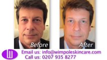 Non-Surgical Face-Lift by the Wimpole Medical Centre