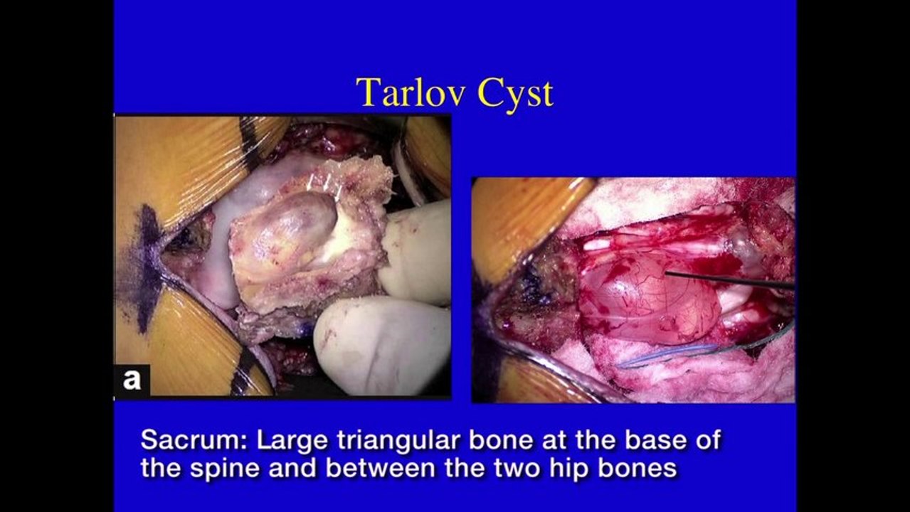 UCSF Radiology - Back Pain Related to Tarlov Cysts