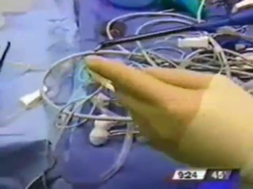 ENT Specialist in Chicago - Shrinking Tonsils - Procedure