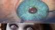 Wild New Plastic Surgery: Iris Implants To Change Eye Color